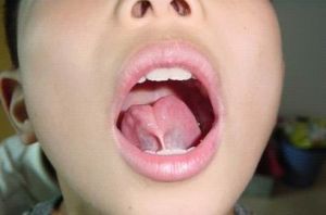 舌系带短吃奶表现图片