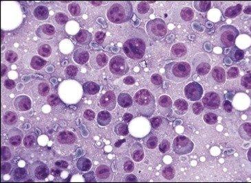 漿細胞瘤