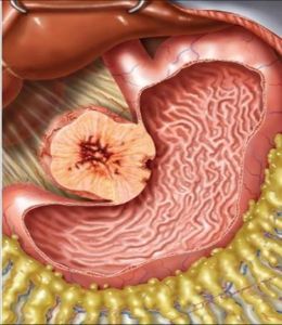 胃肠间质瘤