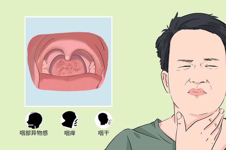 慢性单纯性咽炎
